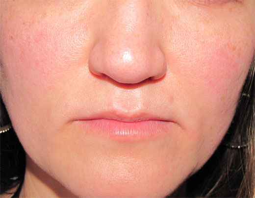 ROSACEA