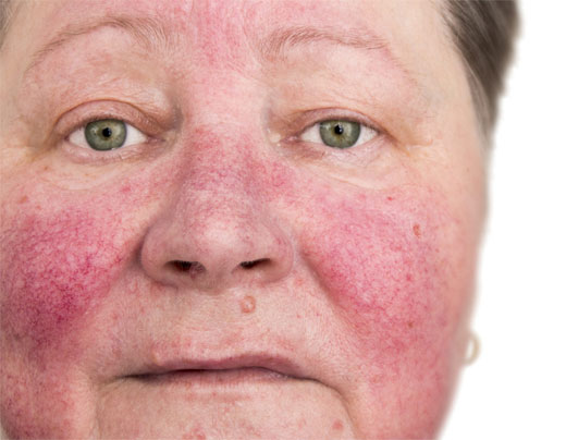 ROSACEA